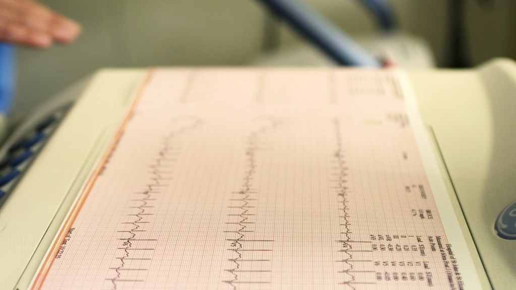 ‘Broken Heart Syndrome’ Cases Surge Throughout Pandemic With Women Most Likely to Be&nbsp;Detected